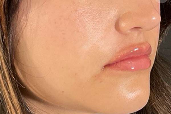Lip fillers Before & After Image